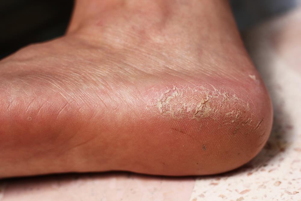 Calluses  Middletown NJ 