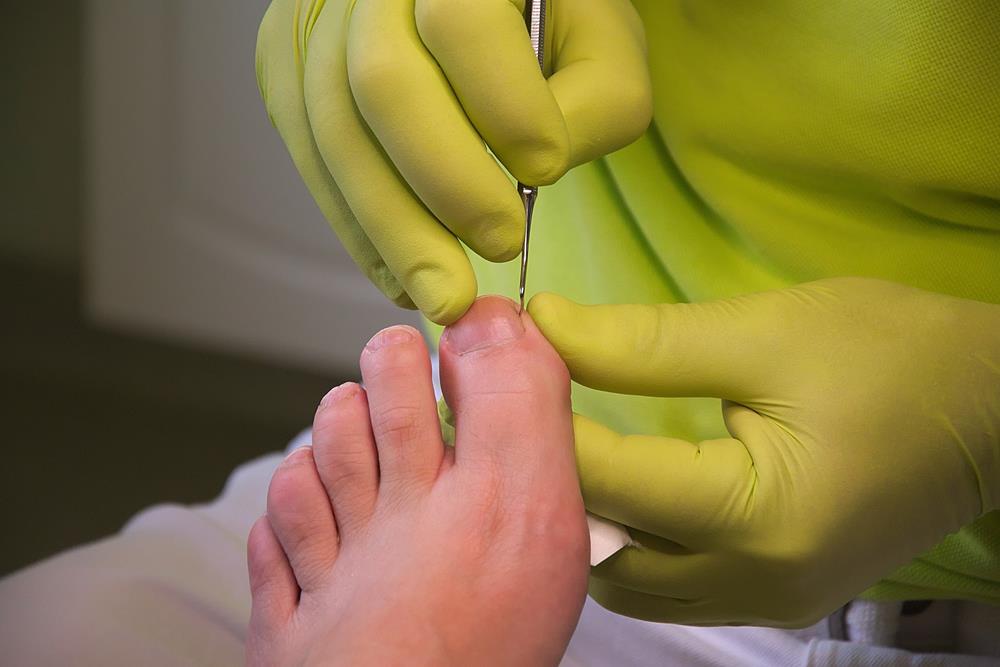 Ingrown Toenails  Middletown NJ 